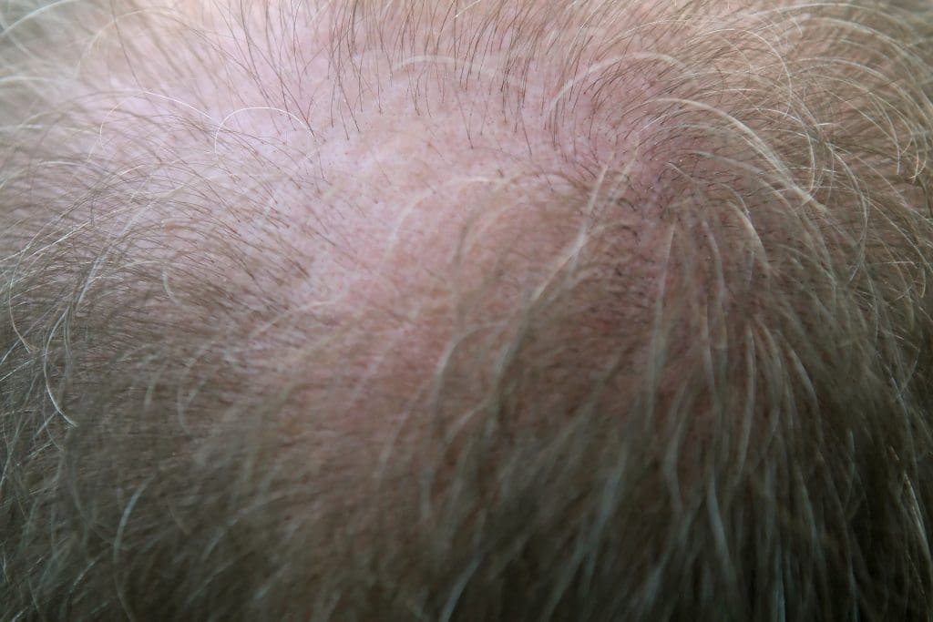 Hair Loss What You Need To Know